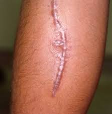 Cicatrice ipertrofica o cheloide: prevenzione e trattamento