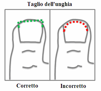 L'unghia incarnita: quale trattamento?